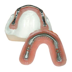 Bar overdenture on implants Bar overdenture on implants