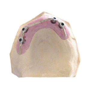 Bar overdenture on implants Bar overdenture on implants